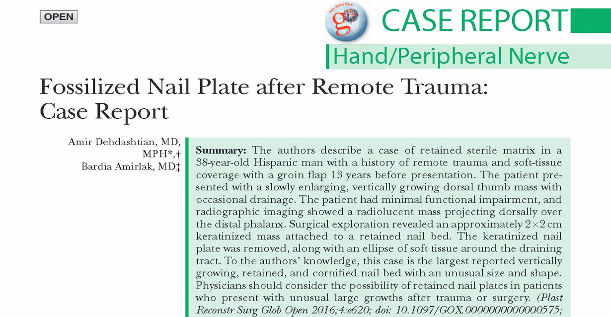 Fossilized Nail Plate after Remote Trauma: Case Report
