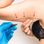 Arm Liposuction Dallas TX