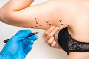 Arm Liposuction Dallas TX