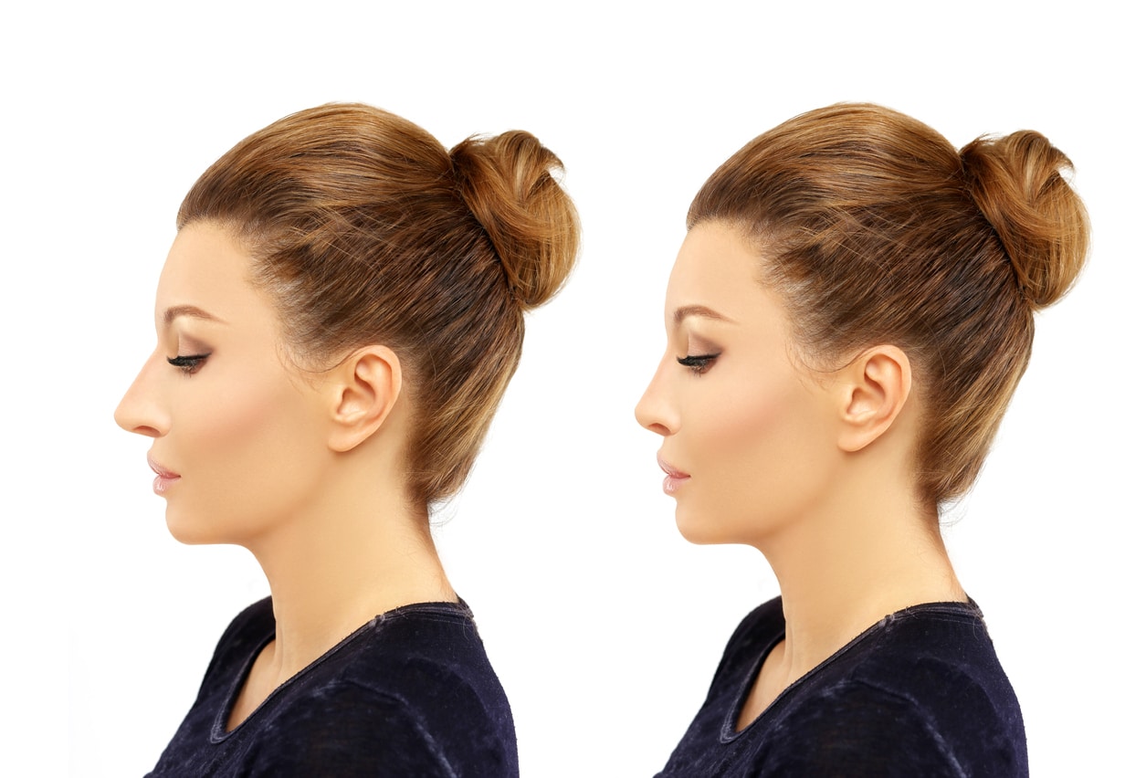 rhinoplasty dallas tx