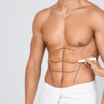 Man's Fit Torso With Surgical Lines On His Body Before Operation.