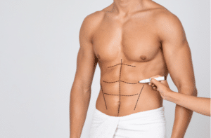 Man's Fit Torso With Surgical Lines On His Body Before Operation. 