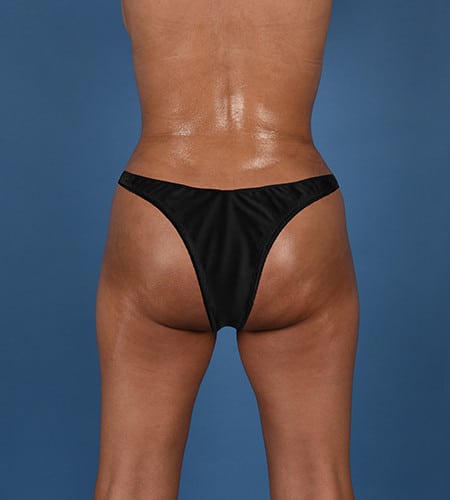 ADOR™ Protocol modified Brazilian Butt Lift after photo. Individual results may vary.