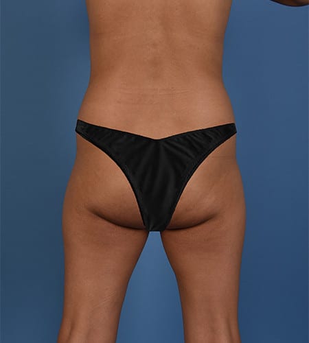ADOR™ Protocol modified Brazilian Butt Lift before photo. Individual results may vary.