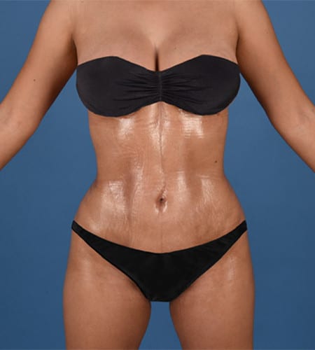 laser liposuction amirlak plastic surgery dallas texas after photo