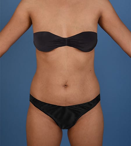 laser liposuction amirlak plastic surgery dallas texas before photo